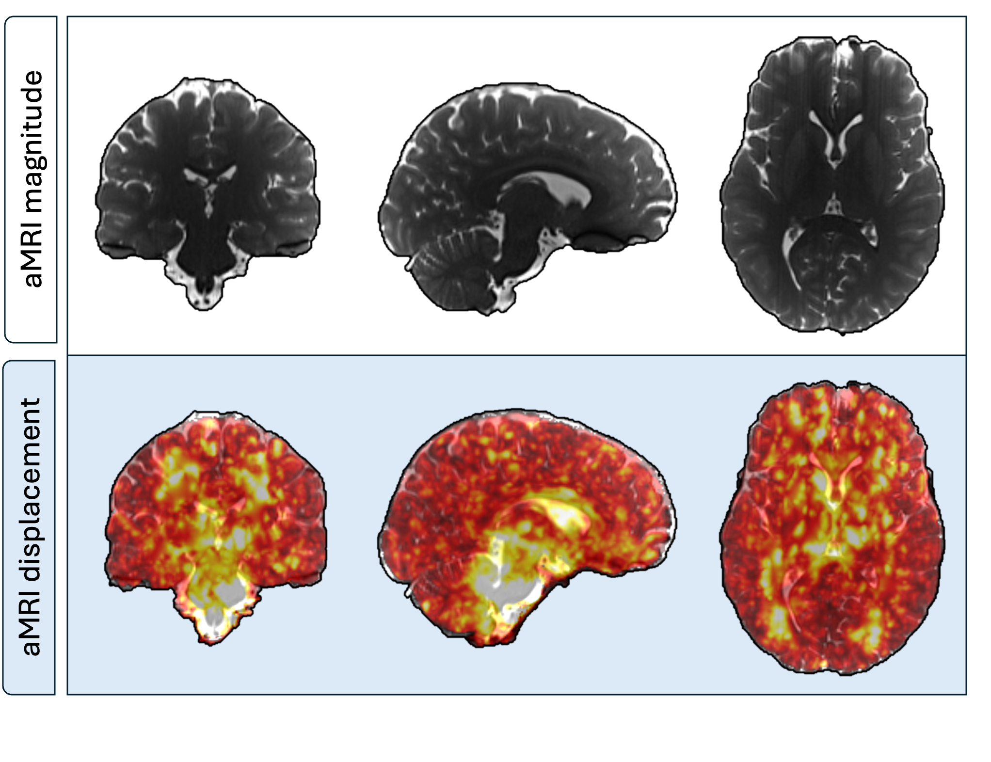 Representative 3D displacement maps of one subject (female, 24 years old) derived from aMRI. The top row shows the coronal, sagittal, and axial slices of a structural aMRI magnitude image for morphological context, while the bottom row shows displacement fields overlaid; greater pulsatility during the cardiac cycle is seen in areas surrounding the brainstem and cerebrospinal filled regions.
