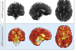 Representative 3D displacement maps of one subject (female, 24 years old) derived from aMRI. The top row shows the coronal, sagittal, and axial slices of a structural aMRI magnitude image for morphological context, while the bottom row shows displacement fields overlaid; greater pulsatility during the cardiac cycle is seen in areas surrounding the brainstem and cerebrospinal filled regions.