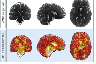 Representative 3D displacement maps of one subject (female, 24 years old) derived from aMRI. The top row shows the coronal, sagittal, and axial slices of a structural aMRI magnitude image for morphological context, while the bottom row shows displacement fields overlaid; greater pulsatility during the cardiac cycle is seen in areas surrounding the brainstem and cerebrospinal filled regions.