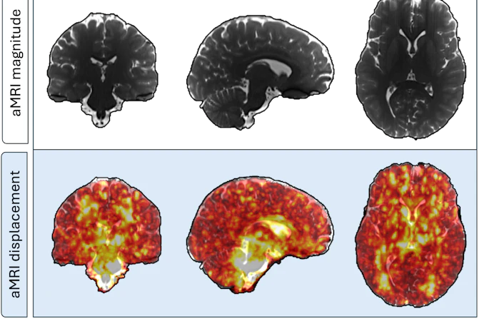 Representative 3D displacement maps of one subject (female, 24 years old) derived from aMRI. The top row shows the coronal, sagittal, and axial slices of a structural aMRI magnitude image for morphological context, while the bottom row shows displacement fields overlaid; greater pulsatility during the cardiac cycle is seen in areas surrounding the brainstem and cerebrospinal filled regions.