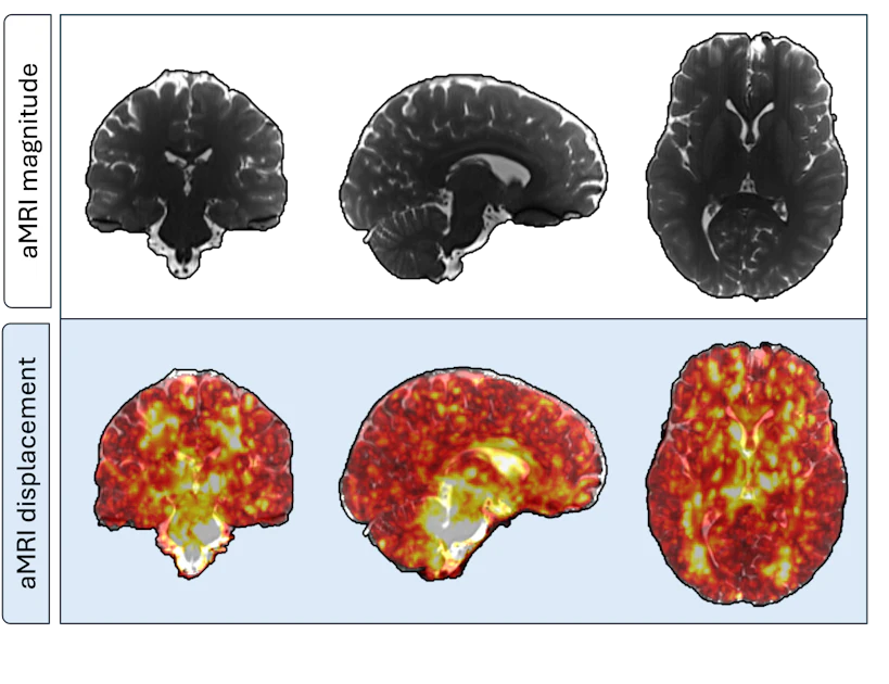 ISMRM: 3D amplified MRI reveals age-related drop in brain pulsatility