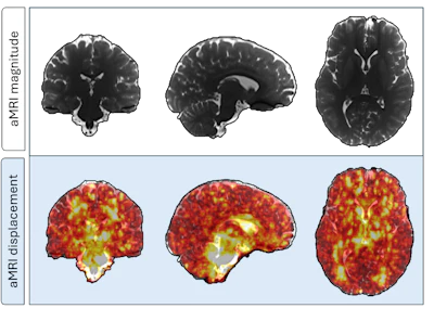 Representative 3D displacement maps of one subject (female, 24 years old) derived from aMRI. The top row shows the coronal, sagittal, and axial slices of a structural aMRI magnitude image for morphological context, while the bottom row shows displacement fields overlaid; greater pulsatility during the cardiac cycle is seen in areas surrounding the brainstem and cerebrospinal filled regions.