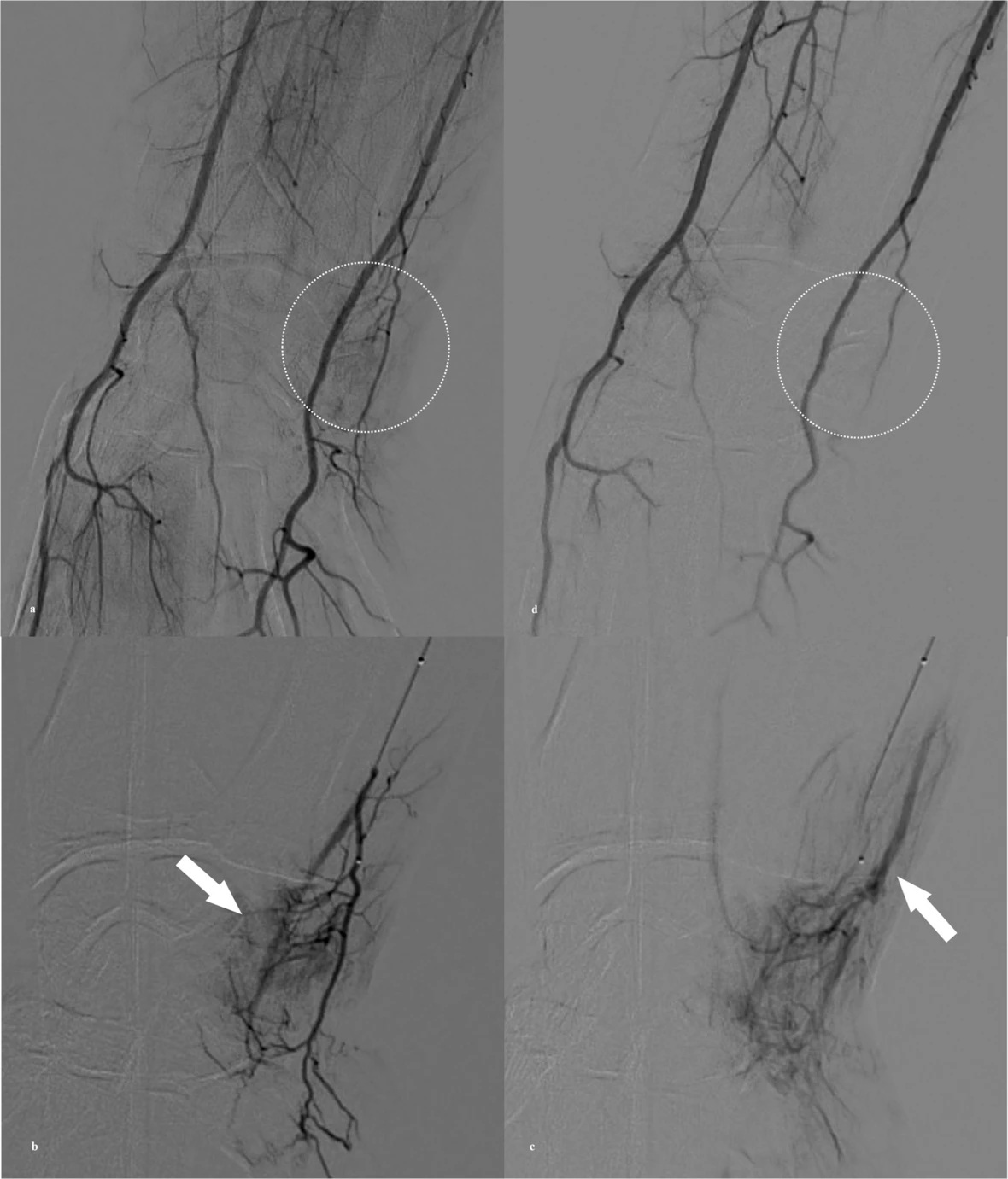 A 44-year-old woman with TFCC injury treated by transcatheter arterial embolization (TAE). a) Right brachial arteriography via common femoral artery access with a 5-Fr catheter demonstrates hyperstaining on the ulnar side of the wrist joint (white circle). b) An ulnar artery branch is superselected with a 1.9-Fr microcatheter, showing hypervascular staining corresponding to the pain site (white arrow). c) Delayed-phase angiography reveals early venous drainage (white arrow) adjacent to the hyperstaining, a finding often observed in TAE and considered an additional marker for embolization. d) Final angiography after injection of 0.5 mL quick-soluble gelatin sponge particles (QS-GSPs) demonstrates resolution of the hyperstaining (white circle). The VAS pain score improved from 7 at baseline to 1 at six months.