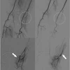 A 44-year-old woman with TFCC injury treated by transcatheter arterial embolization (TAE). a) Right brachial arteriography via common femoral artery access with a 5-Fr catheter demonstrates hyperstaining on the ulnar side of the wrist joint (white circle). b) An ulnar artery branch is superselected with a 1.9-Fr microcatheter, showing hypervascular staining corresponding to the pain site (white arrow). c) Delayed-phase angiography reveals early venous drainage (white arrow) adjacent to the hyperstaining, a finding often observed in TAE and considered an additional marker for embolization. d) Final angiography after injection of 0.5 mL quick-soluble gelatin sponge particles (QS-GSPs) demonstrates resolution of the hyperstaining (white circle). The VAS pain score improved from 7 at baseline to 1 at six months.