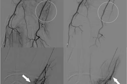 A 44-year-old woman with TFCC injury treated by transcatheter arterial embolization (TAE). a) Right brachial arteriography via common femoral artery access with a 5-Fr catheter demonstrates hyperstaining on the ulnar side of the wrist joint (white circle). b) An ulnar artery branch is superselected with a 1.9-Fr microcatheter, showing hypervascular staining corresponding to the pain site (white arrow). c) Delayed-phase angiography reveals early venous drainage (white arrow) adjacent to the hyperstaining, a finding often observed in TAE and considered an additional marker for embolization. d) Final angiography after injection of 0.5 mL quick-soluble gelatin sponge particles (QS-GSPs) demonstrates resolution of the hyperstaining (white circle). The VAS pain score improved from 7 at baseline to 1 at six months.