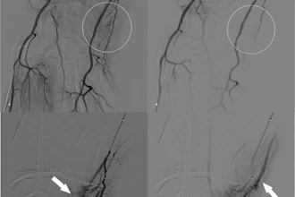 A 44-year-old woman with TFCC injury treated by transcatheter arterial embolization (TAE). a) Right brachial arteriography via common femoral artery access with a 5-Fr catheter demonstrates hyperstaining on the ulnar side of the wrist joint (white circle). b) An ulnar artery branch is superselected with a 1.9-Fr microcatheter, showing hypervascular staining corresponding to the pain site (white arrow). c) Delayed-phase angiography reveals early venous drainage (white arrow) adjacent to the hyperstaining, a finding often observed in TAE and considered an additional marker for embolization. d) Final angiography after injection of 0.5 mL quick-soluble gelatin sponge particles (QS-GSPs) demonstrates resolution of the hyperstaining (white circle). The VAS pain score improved from 7 at baseline to 1 at six months.