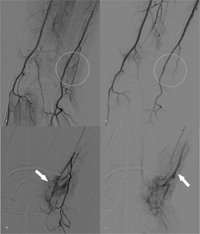 A 44-year-old woman with TFCC injury treated by transcatheter arterial embolization (TAE). a) Right brachial arteriography via common femoral artery access with a 5-Fr catheter demonstrates hyperstaining on the ulnar side of the wrist joint (white circle). b) An ulnar artery branch is superselected with a 1.9-Fr microcatheter, showing hypervascular staining corresponding to the pain site (white arrow). c) Delayed-phase angiography reveals early venous drainage (white arrow) adjacent to the hyperstaining, a finding often observed in TAE and considered an additional marker for embolization. d) Final angiography after injection of 0.5 mL quick-soluble gelatin sponge particles (QS-GSPs) demonstrates resolution of the hyperstaining (white circle). The VAS pain score improved from 7 at baseline to 1 at six months.