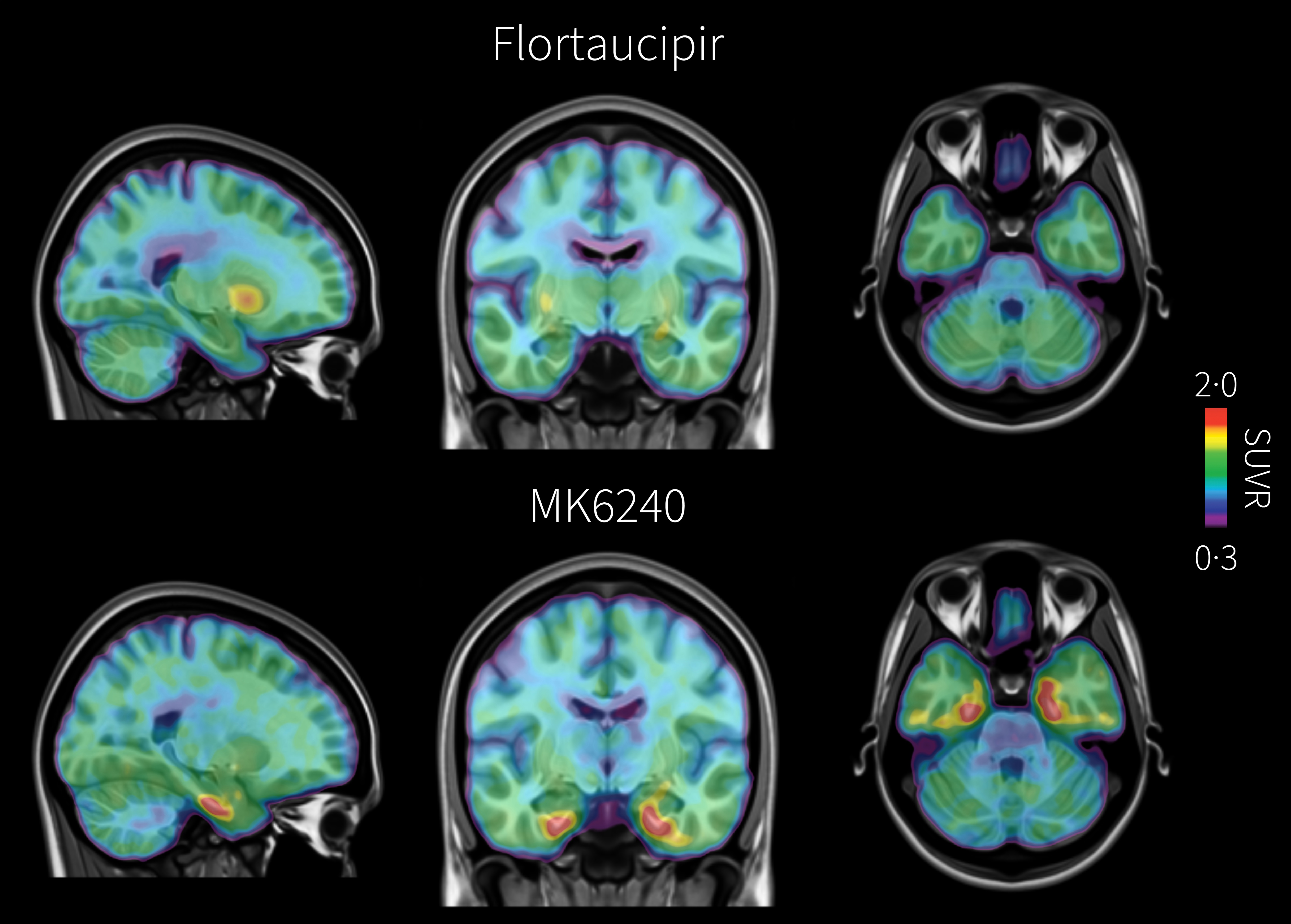 PET brain scans from the same individual with early signs of Alzheimer&rsquo;s disease comparing two tau radiotracers: flortaucipir, shown at top, and the investigational tracer MK6240, shown at bottom. Areas of pathological tau accumulation appear in red. The MK6240 scan shows more extensive tau buildup, suggesting that this tracer may detect Alzheimer&rsquo;s-related brain changes that are less visible with the standard tracer.