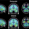 PET brain scans from the same individual with early signs of Alzheimer’s disease comparing two tau radiotracers: flortaucipir, shown at top, and the investigational tracer MK6240, shown at bottom. Areas of pathological tau accumulation appear in red. The MK6240 scan shows more extensive tau buildup, suggesting that this tracer may detect Alzheimer’s-related brain changes that are less visible with the standard tracer.