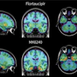 PET brain scans from the same individual with early signs of Alzheimer’s disease comparing two tau radiotracers: flortaucipir, shown at top, and the investigational tracer MK6240, shown at bottom. Areas of pathological tau accumulation appear in red. The MK6240 scan shows more extensive tau buildup, suggesting that this tracer may detect Alzheimer’s-related brain changes that are less visible with the standard tracer.