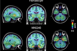 PET brain scans from the same individual with early signs of Alzheimer’s disease comparing two tau radiotracers: flortaucipir, shown at top, and the investigational tracer MK6240, shown at bottom. Areas of pathological tau accumulation appear in red. The MK6240 scan shows more extensive tau buildup, suggesting that this tracer may detect Alzheimer’s-related brain changes that are less visible with the standard tracer.