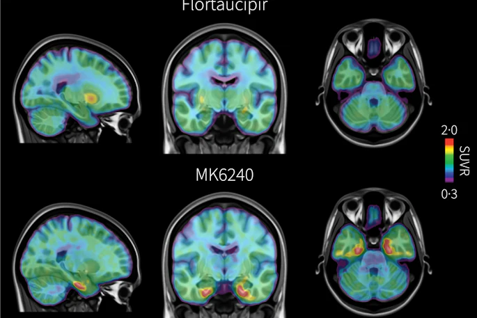 PET brain scans from the same individual with early signs of Alzheimer’s disease comparing two tau radiotracers: flortaucipir, shown at top, and the investigational tracer MK6240, shown at bottom. Areas of pathological tau accumulation appear in red. The MK6240 scan shows more extensive tau buildup, suggesting that this tracer may detect Alzheimer’s-related brain changes that are less visible with the standard tracer.