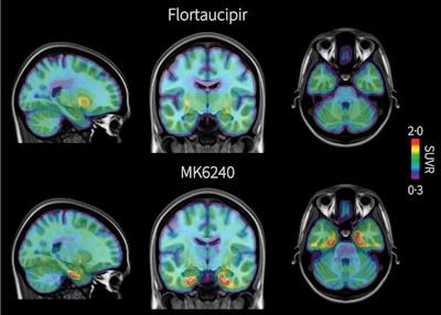 PET brain scans from the same individual with early signs of Alzheimer’s disease comparing two tau radiotracers: flortaucipir, shown at top, and the investigational tracer MK6240, shown at bottom. Areas of pathological tau accumulation appear in red. The MK6240 scan shows more extensive tau buildup, suggesting that this tracer may detect Alzheimer’s-related brain changes that are less visible with the standard tracer.