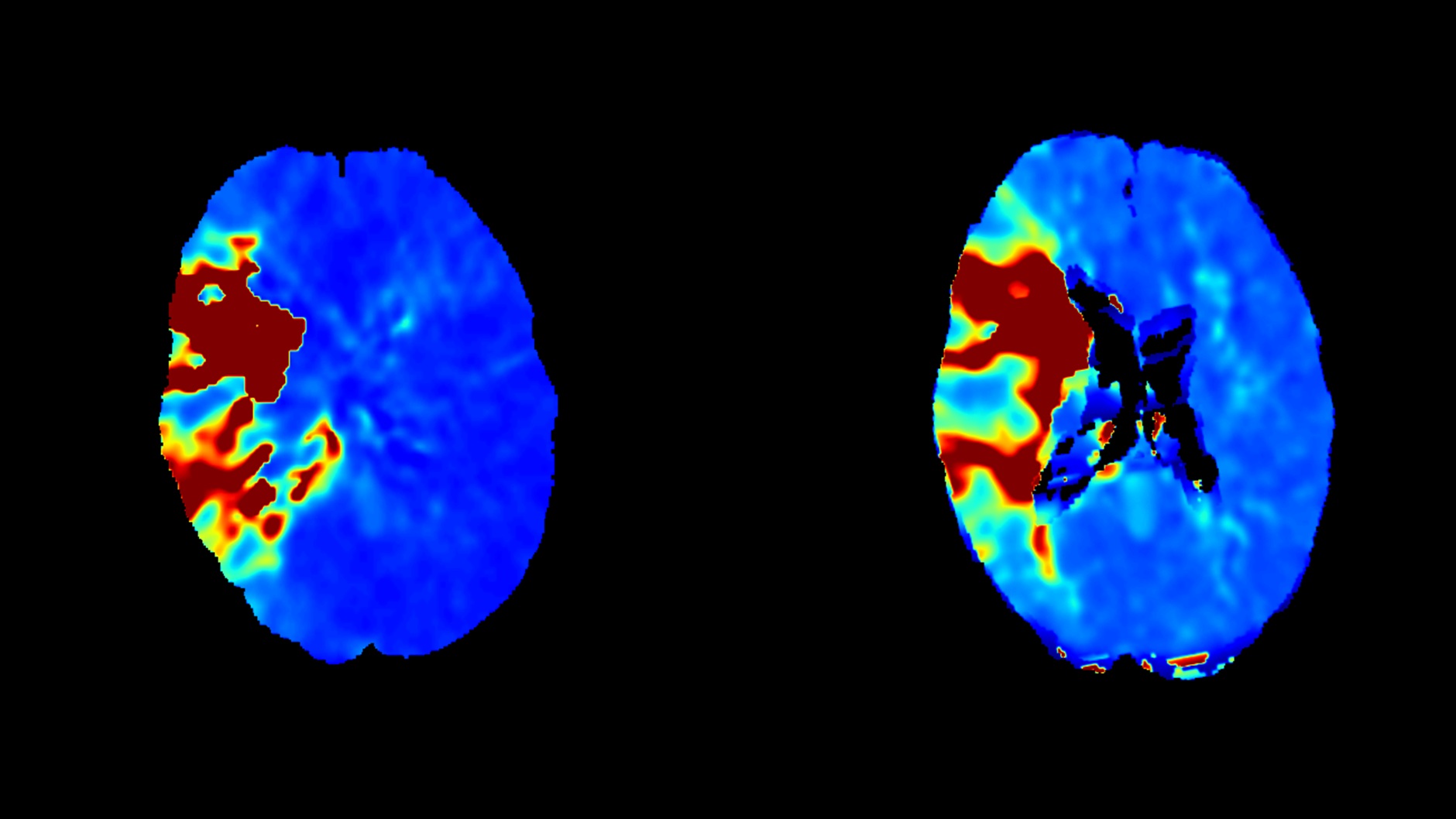 Tmax perfusion maps: Conebeam CT perfusion on the left, compared to conventional CT perfusion on the right.