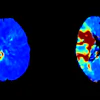 Tmax perfusion maps: Conebeam CT perfusion on the left, compared to conventional CT perfusion on the right.