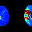 Tmax perfusion maps: Conebeam CT perfusion on the left, compared to conventional CT perfusion on the right.