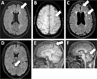 Illustrations of brain MRI abnormalities observed in a population of former professional motorsport drivers. (A) A left frontal lacune observed in axial T2-weighted 3D FLAIR sequence; (B) a left frontal microbleed observed in axial SWIp sequence in a 77-year-old participant. (C) Frontal lobes atrophy and white matter hyperintensities scored 2 on Fazekas’ scale with confluent periventricular lesions and “multi-spot pattern” for the deep white matter observed in axial T2-weighted 3D FLAIR sequence in a 68-year-old participant. (D) a micronodular vacuolating neuronal tumor incidentally discovered in axial T2-weighted 3D FLAIR in 54-year-old participant. (E) Frontal and parietal lobes atrophies in a 43-year-old participant. (F) Cerebellar atrophy in a 53-year-old participant observed in sagittal T1-weighted 3D sequence.