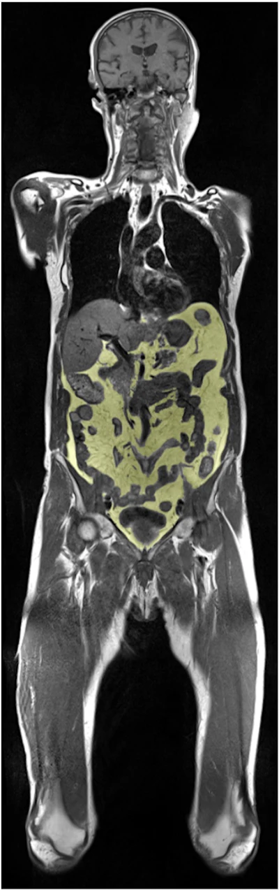 Single slice example image from coronal T1-weighted whole body MRI with color-overlay on intra-abdominal visceral fat from automated AI-segmentation.
