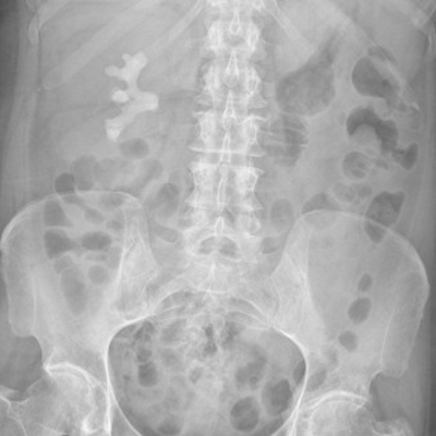 X Ray Abdominal3 400