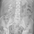 X Ray Abdominal3 400