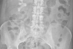 X Ray Abdominal3 400