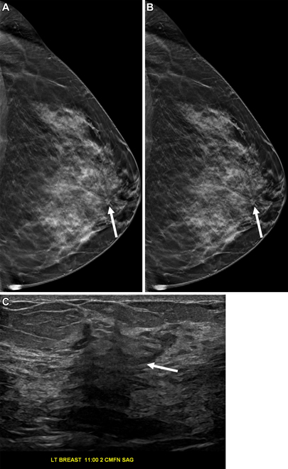 Slab reconstruction provides visualization of subtle architectural distortion similar to that of standard 1-mm slices in a false-positive screening exam. Images include breast exams from a 45-year-old woman who underwent screening mammography. Craniocaudal tomosynthesis images with (A) 1-mm slices and (B) 6-mm slab reconstructions show an area of architectural distortion in the subareolar region of the left breast (arrow). (C) Targeted ultrasound imaging shows a corresponding irregular hypoechoic mass (arrow), which was subsequently biopsied. Pathologic examination revealed a sclerosing papillary lesion.
