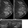Slab reconstruction provides visualization of subtle architectural distortion similar to that of standard 1-mm slices in a false-positive screening exam. Images include breast exams from a 45-year-old woman who underwent screening mammography. Craniocaudal tomosynthesis images with (A) 1-mm slices and (B) 6-mm slab reconstructions show an area of architectural distortion in the subareolar region of the left breast (arrow). (C) Targeted ultrasound imaging shows a corresponding irregular hypoechoic mass (arrow), which was subsequently biopsied. Pathologic examination revealed a sclerosing papillary lesion.