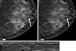 Slab reconstruction provides visualization of subtle architectural distortion similar to that of standard 1-mm slices in a false-positive screening exam. Images include breast exams from a 45-year-old woman who underwent screening mammography. Craniocaudal tomosynthesis images with (A) 1-mm slices and (B) 6-mm slab reconstructions show an area of architectural distortion in the subareolar region of the left breast (arrow). (C) Targeted ultrasound imaging shows a corresponding irregular hypoechoic mass (arrow), which was subsequently biopsied. Pathologic examination revealed a sclerosing papillary lesion.