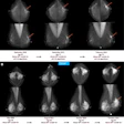 Screening mammograms and AI score changes are depicted over time in two individuals with screen-detected cancer. Full-field digital mammograms show craniocaudal (top) and mediolateral (bottom) views of the left and right breast. The description below each mammogram indicates whether AI scores from three AI-based computer-aided detection systems (AI-1, AI-2, and AI-3) were above or below the 90th percentile. (A) Mammograms from three screening time points (in 2009, 2011, and 2014) in an individual who was diagnosed in February 2014 (at age 73 years) with a left-sided 25-mm grade 2 invasive breast carcinoma, no special type (arrow). Mammographic breast density was classified as BI-RADS B on all three mammograms. (B) Mammograms from four screening time points (in 2009, 2011, 2013, and 2015) in an individual who was diagnosed in October 2015 (at age 65 years) with a left-sided 45-mm grade 2 lobular carcinoma (arrow). Mammographic breast density was classified as BI-RADS C on all four mammograms. Screen-detected cancers were defined as those diagnosed within 90 days for individuals who were recalled at screening (*).
