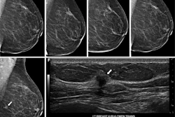 Images in a 75-year-old woman who underwent routine screening mammography in 2022. Left mediolateral oblique views shown from prior screening mammograms: (A) 2015, (B) 2018, (C) 2019, and (D) 2021. In (E) 2022, a new mass developed in the left breast at the 6-o’clock position (arrow), with a (F) corresponding irregular mass at ultrasound (arrow). Subsequent ultrasound-guided core needle biopsy yielded invasive ductal carcinoma, grade 2. The deep learning five-year risk scores gradually increased from 2.0 (2015) to 2.1 (2018), 3.4 (2019), 3.6 (2021), and 15.3 (2022). CMFN = centimeters from nipple, LT = left, TRANS = transverse.