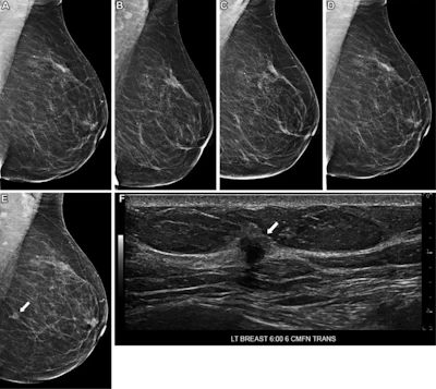 Images in a 75-year-old woman who underwent routine screening mammography in 2022. Left mediolateral oblique views shown from prior screening mammograms: (A) 2015, (B) 2018, (C) 2019, and (D) 2021. In (E) 2022, a new mass developed in the left breast at the 6-o’clock position (arrow), with a (F) corresponding irregular mass at ultrasound (arrow). Subsequent ultrasound-guided core needle biopsy yielded invasive ductal carcinoma, grade 2. The deep learning five-year risk scores gradually increased from 2.0 (2015) to 2.1 (2018), 3.4 (2019), 3.6 (2021), and 15.3 (2022). CMFN = centimeters from nipple, LT = left, TRANS = transverse.
