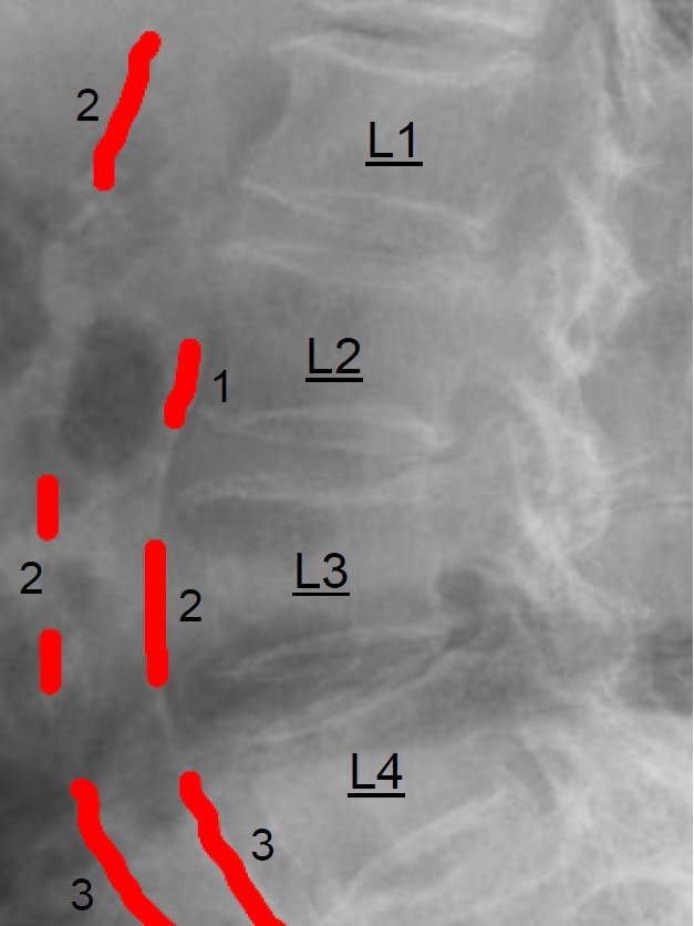 Abdominal aortic calcification (AAC) score grading: 0 - no calcific deposits in front of the vertebrae; 1 - small scattered calcific deposits filling less than 1/3 of the longitudinal wall of the aorta; 2 - 1/3-2/3 of the wall calcified; 3 - 2/3 or more of the wall calcified.