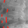 Abdominal aortic calcification (AAC) score grading: 0 - no calcific deposits in front of the vertebrae; 1 - small scattered calcific deposits filling less than 1/3 of the longitudinal wall of the aorta; 2 - 1/3-2/3 of the wall calcified; 3 - 2/3 or more of the wall calcified.