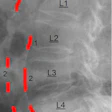 Abdominal aortic calcification (AAC) score grading: 0 - no calcific deposits in front of the vertebrae; 1 - small scattered calcific deposits filling less than 1/3 of the longitudinal wall of the aorta; 2 - 1/3-2/3 of the wall calcified; 3 - 2/3 or more of the wall calcified.
