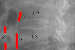 Abdominal aortic calcification (AAC) score grading: 0 - no calcific deposits in front of the vertebrae; 1 - small scattered calcific deposits filling less than 1/3 of the longitudinal wall of the aorta; 2 - 1/3-2/3 of the wall calcified; 3 - 2/3 or more of the wall calcified.