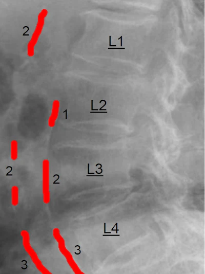 Abdominal aortic calcification (AAC) score grading: 0 - no calcific deposits in front of the vertebrae; 1 - small scattered calcific deposits filling less than 1/3 of the longitudinal wall of the aorta; 2 - 1/3-2/3 of the wall calcified; 3 - 2/3 or more of the wall calcified.