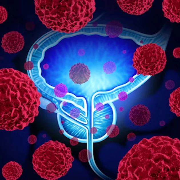 Experts propose new MRI standards for prostate cancer screening