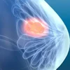 Breast Update 2 T76 Vuzvgq