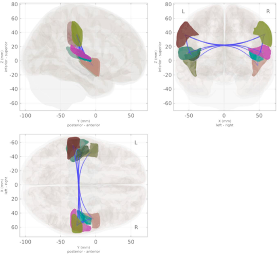 Network-level analysis comparing functional association strength between ROIs of pre- and postmenopausal groups. Lower levels of connectivity were identified among one cluster (F3,106 = 8.84, Puncorrected < 0.001, PFDR = 0.012) in the postmenopausal group, which included the right supramarginal gyrus anterior division, right planum temporale, and right Heschl&rsquo;s gyrus, among others. FDR, false discovery rate; ROI, region of interest.