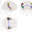 Network-level analysis comparing functional association strength between ROIs of pre- and postmenopausal groups. Lower levels of connectivity were identified among one cluster (F3,106 = 8.84, Puncorrected < 0.001, PFDR = 0.012) in the postmenopausal group, which included the right supramarginal gyrus anterior division, right planum temporale, and right Heschl’s gyrus, among others. FDR, false discovery rate; ROI, region of interest.