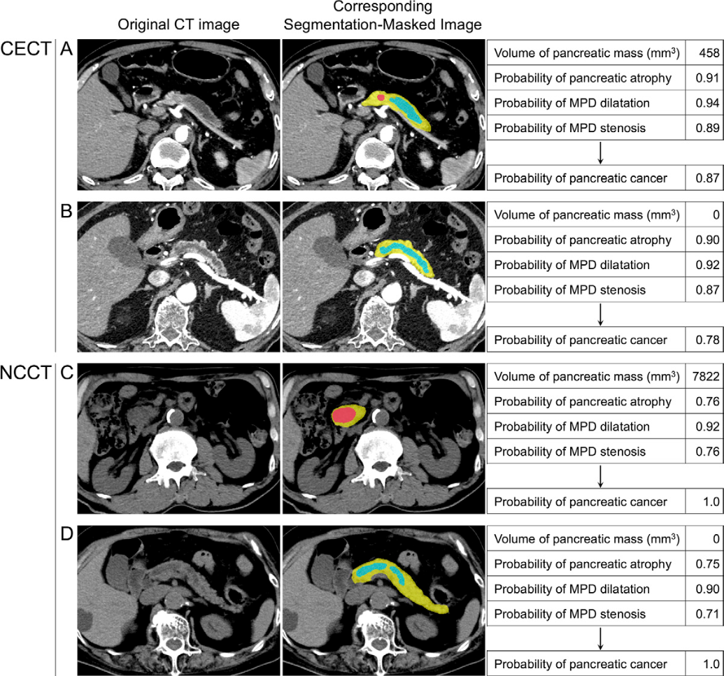 Representative images in patients with pancreatic cancer (PC) diagnosed by the deep learning (DL) models. Original axial images (left), corresponding segmentation-masked images (middle), and DL model outputs (right) are shown. The segmented areas of the pancreatic parenchyma, main pancreatic duct (MPD), and pancreatic masses are indicated by yellow, teal, and red overlay, respectively. (A) Contrast-enhanced CT (CECT) images in an 84-year-old man with worsening diabetes mellitus show a 10-mm mass in the pancreatic body with upstream MPD stenosis and dilatation and parenchymal atrophy. The tumor was pathologically confirmed as PC (T1b). (B) CECT images in an 83-year-old man undergoing postoperative surveillance for gastric gastrointestinal stromal tumor show MPD stenosis and dilatation with parenchymal atrophy without a visible mass. The tumor was pathologically confirmed as PC (tumor in situ). (C) Noncontrast CT (NCCT) images in a 65-year-old man undergoing follow-up for mantle cell lymphoma show a 32-mm mass in the pancreatic head with MPD stenosis and dilatation. The tumor was pathologically confirmed as PC (T2). (D) NCCT images in an 81-year-old woman with abdominal distension show MPD stenosis and dilatation with parenchymal atrophy without a visible mass. The tumor was pathologically confirmed as PC (T1b).