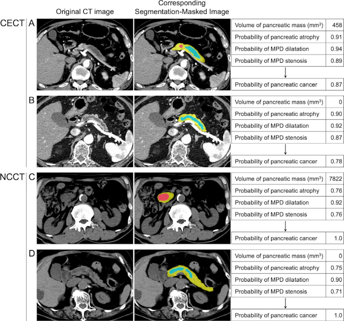 AI matches physicians in pancreatic cancer detection on CT