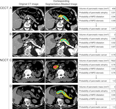 Representative images in patients with pancreatic cancer (PC) diagnosed by the deep learning (DL) models. Original axial images (left), corresponding segmentation-masked images (middle), and DL model outputs (right) are shown. The segmented areas of the pancreatic parenchyma, main pancreatic duct (MPD), and pancreatic masses are indicated by yellow, teal, and red overlay, respectively. (A) Contrast-enhanced CT (CECT) images in an 84-year-old man with worsening diabetes mellitus show a 10-mm mass in the pancreatic body with upstream MPD stenosis and dilatation and parenchymal atrophy. The tumor was pathologically confirmed as PC (T1b). (B) CECT images in an 83-year-old man undergoing postoperative surveillance for gastric gastrointestinal stromal tumor show MPD stenosis and dilatation with parenchymal atrophy without a visible mass. The tumor was pathologically confirmed as PC (tumor in situ). (C) Noncontrast CT (NCCT) images in a 65-year-old man undergoing follow-up for mantle cell lymphoma show a 32-mm mass in the pancreatic head with MPD stenosis and dilatation. The tumor was pathologically confirmed as PC (T2). (D) NCCT images in an 81-year-old woman with abdominal distension show MPD stenosis and dilatation with parenchymal atrophy without a visible mass. The tumor was pathologically confirmed as PC (T1b).