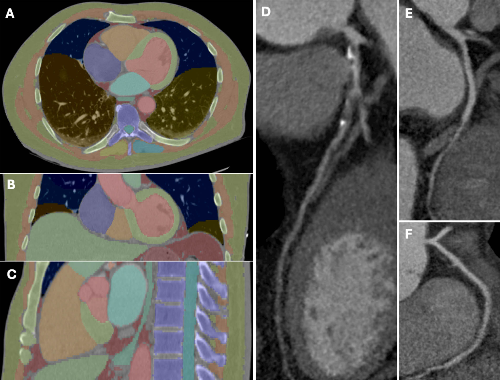 An example of machine learning&ndash;based multiorgan body composition assessment (TotalSegmentator V2.0.4, 1.5-mm high-resolution model) in a 63-year-old man with obstructive coronary artery disease and a skeletal muscle attenuation below the median. (A) Transverse, (B) coronal, and (C) sagittal CT images and curved planar reformations of the (D) left, (E) circumflex, and (F) right coronary arteries.