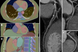 An example of machine learning–based multiorgan body composition assessment (TotalSegmentator V2.0.4, 1.5-mm high-resolution model) in a 63-year-old man with obstructive coronary artery disease and a skeletal muscle attenuation below the median. (A) Transverse, (B) coronal, and (C) sagittal CT images and curved planar reformations of the (D) left, (E) circumflex, and (F) right coronary arteries.