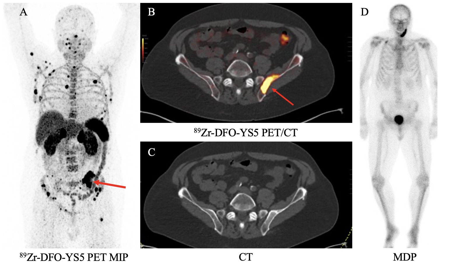 A 74-year-old patient with metastatic prostate cancer with a positive left iliac wing lesion (SUVmax of 35.02) seen on (A) Zr-89 DFO-YS5 PET maximum projection image (MIP) and (B) PET/CT (red arrows). The lesion was graded 5 on PET but was not visible on CT (D) or (D) technitium-99 MDP bone scan.