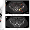A 74-year-old patient with metastatic prostate cancer with a positive left iliac wing lesion (SUVmax of 35.02) seen on (A) Zr-89 DFO-YS5 PET maximum projection image (MIP) and (B) PET/CT (red arrows). The lesion was graded 5 on PET but was not visible on CT (D) or (D) technitium-99 MDP bone scan.