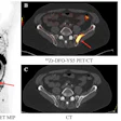 A 74-year-old patient with metastatic prostate cancer with a positive left iliac wing lesion (SUVmax of 35.02) seen on (A) Zr-89 DFO-YS5 PET maximum projection image (MIP) and (B) PET/CT (red arrows). The lesion was graded 5 on PET but was not visible on CT (D) or (D) technitium-99 MDP bone scan.