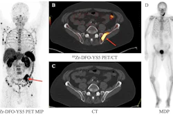 A 74-year-old patient with metastatic prostate cancer with a positive left iliac wing lesion (SUVmax of 35.02) seen on (A) Zr-89 DFO-YS5 PET maximum projection image (MIP) and (B) PET/CT (red arrows). The lesion was graded 5 on PET but was not visible on CT (D) or (D) technitium-99 MDP bone scan.