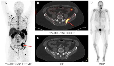A 74-year-old patient with metastatic prostate cancer with a positive left iliac wing lesion (SUVmax of 35.02) seen on (A) Zr-89 DFO-YS5 PET maximum projection image (MIP) and (B) PET/CT (red arrows). The lesion was graded 5 on PET but was not visible on CT (D) or (D) technitium-99 MDP bone scan.